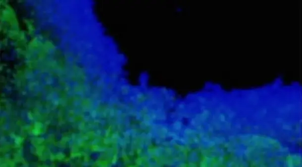 toxic stem cells brain tumour