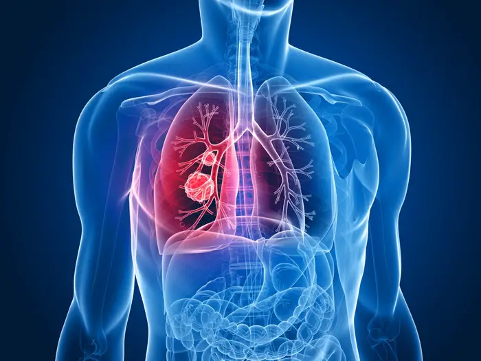 lung cancer illustration