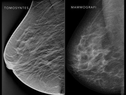 tomosynthesis vs mammography