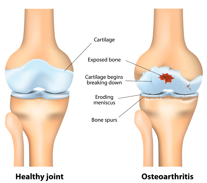 3d-bioprinted cartilage future technology timeline