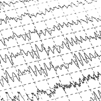 epilepsy graph