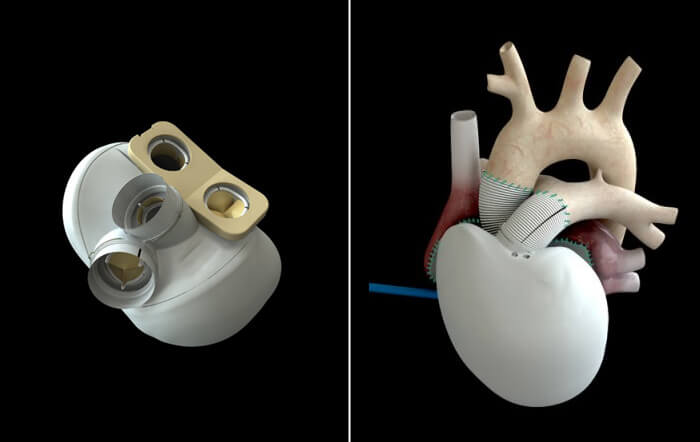 artificial heart 2013 2015 technology