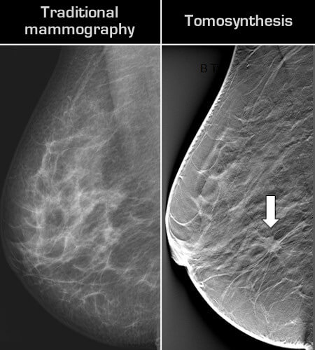 breast tomosynthesis cancer future timeline 2020 2025